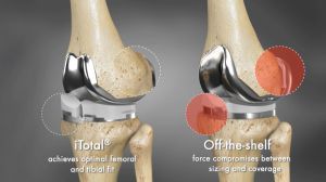 Customized Knee Implants - Susquehanna Orthopaedic Associates